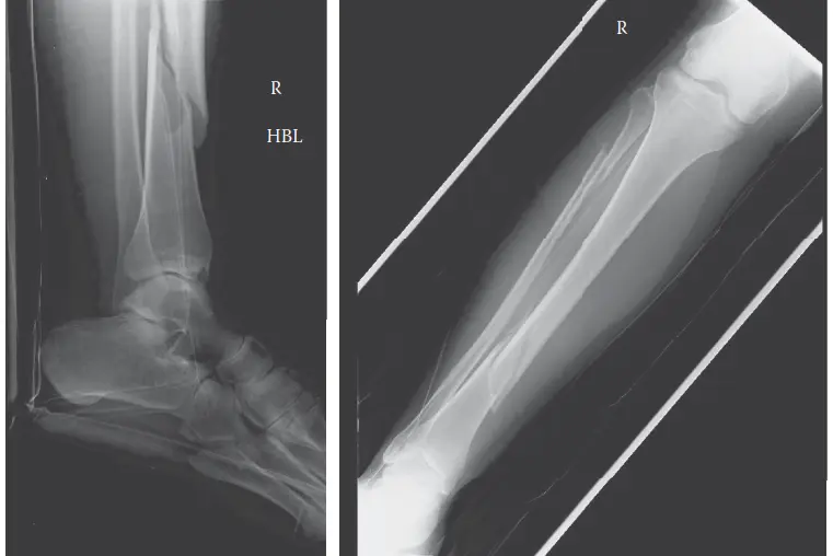 صورة توضيحية لـ متلازمة الحيز الحادة: الدليل الشامل للتشخيص والعلاج مع الأستاذ الدكتور محمد هطيف في صنعاء
