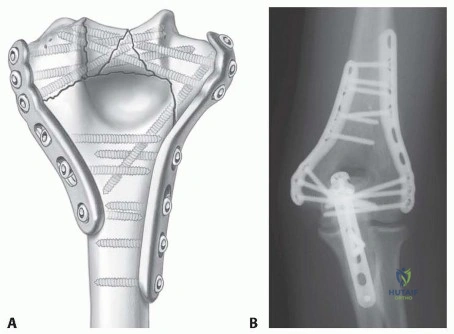 Illustration 2 for Optimizing ORIF for Distal Humerus: Prevent Class II HO