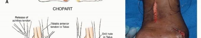 صورة طبية: أورام القدم: دليلك الشامل للعلاج، البتر، والاستئصال مع الأستاذ الدكتور محمد هطيف في صنعاء