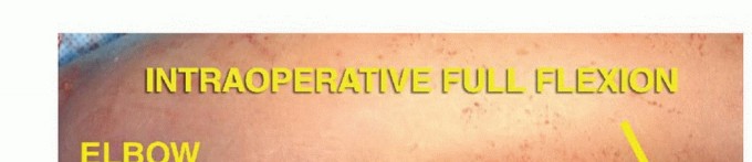 صورة طبية: استئصال الجزء البعيد من عظم العضد: تقنيات آمنة للحفاظ على الطرف في صنعاء مع الأستاذ الدكتور محمد هطيف