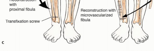 صورة توضيحية لـ استئصال أورام الشظية: دليل شامل للعلاج الحديث والحفاظ على الأطراف مع الأستاذ الدكتور محمد هطيف