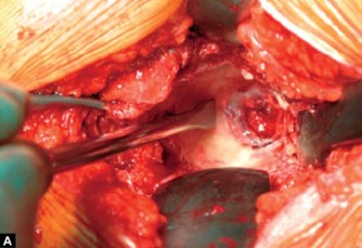 Illustration of acetabular component cementation - Dr. Mohammed Hutaif