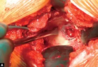 صورة توضيحية لـ تثبيت مفصل الورك بالأسمنت: دليلك الشامل لعملية ناجحة ونتائج تدوم طويلاً في صنعاء