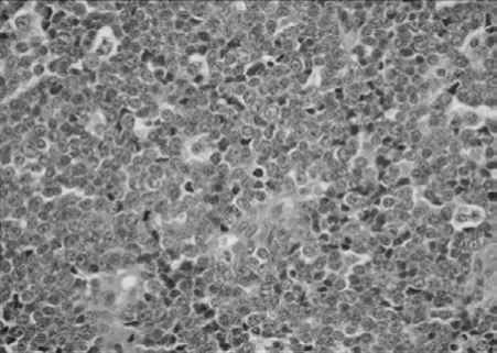 Ace Your Ewing's Sarcoma Examination Questions