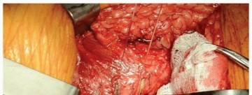 Illustration 3 for Total Hip Arthroplasty: Posterolateral Approach, Extensile & Minimally Invasive