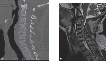 Illustration 32 for Adjacent Segment Degeneration: Your Next Spine Case Solved