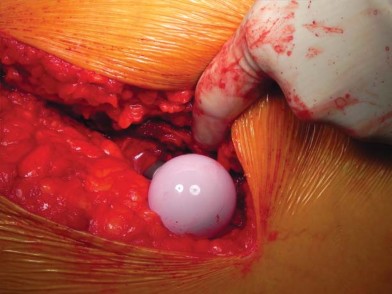 صورة طبية: تقنية الجذع القصير لاستبدال مفصل الورك الكلي: نهج الأستاذ الدكتور محمد هطيف لتدخل جراحي أقل ونتائج أفضل