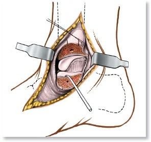 Optimized Approaches to the Dorsum of the Foot & Ankle