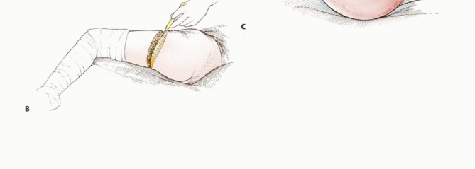 صورة طبية: استئصال مفصل الورك: دليل شامل للمرضى مع الأستاذ الدكتور محمد هطيف