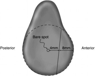 Illustration 4 for Anterior Instability: How Glenoid Bone Loss Shapes Treatment