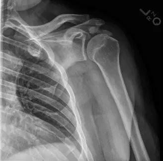 صورة توضيحية لـ تكلس أوتار المرفق: دليل شامل للأسباب، الأعراض، التشخيص والعلاج مع الأستاذ الدكتور محمد هطيف