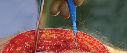 Illustration 29 for Unlock the Figure Posterior Approach to the Hip