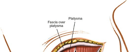 Illustration 5 for Mastering the Anterior Cervical Approach: Longus Colli Muscle Insights