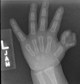 Mastering Wassel: Spotting the Second Most Common Thumb Duplication