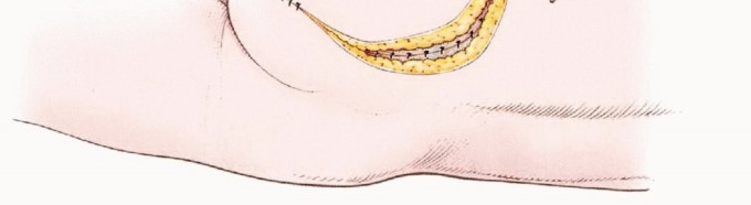 صورة طبية: استئصال نصف الحوض بالرفرفة الأمامية: حلول متقدمة لأورام الحوض الصعبة مع الأستاذ الدكتور محمد هطيف في صنعاء