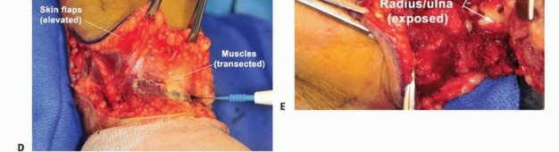 صورة توضيحية لـ بتر الذراع فوق وتحت الكوع: متى ولماذا يصبح ضرورة طبية؟ دليل شامل من الأستاذ الدكتور محمد هطيف