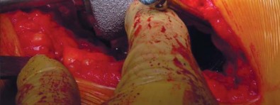 صورة طبية: تقنية الجذع القصير لاستبدال مفصل الورك الكلي: نهج الأستاذ الدكتور محمد هطيف لتدخل جراحي أقل ونتائج أفضل