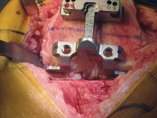 Illustration 28 for Posterior Stabilized Technique: Essential Insights for TKA Success