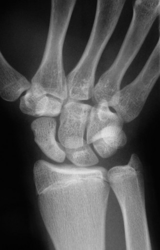 Christine M Kleinert Discussion: Solving Difficult Wrist Fractures