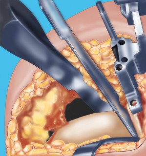 Illustration 44 for Knee Arthroplasty: Avoiding Pitfalls & Benefiting from UKA