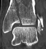 Illustration 13 for Decoding Pilon Fractures: Anterolateral and Medial Fragments Revealed