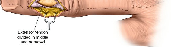 Illustration 174 for Essential Surgical Approaches: Uncover Every Aspect of the Wrist