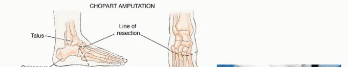 صورة طبية: أورام القدم: دليلك الشامل للعلاج، البتر، والاستئصال مع الأستاذ الدكتور محمد هطيف في صنعاء