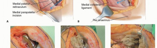 Illustration 6 for Tibial Tubercle Osteotomy: The Key to Extensile Exposure in Revision TKA