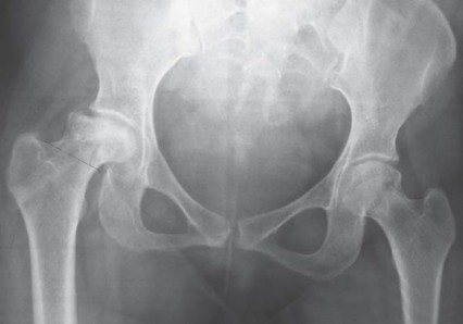 صورة طبية: مفصل الفخذ الصناعي قصير الجذع METHA: حلول مبتكرة للحفاظ على العظم في صنعاء مع الأستاذ الدكتور محمد هطيف