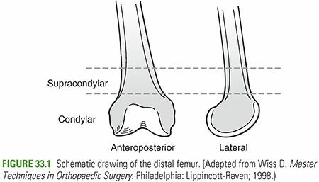 Decoding Distal Femur Fractures: Anatomy, Causes & Management