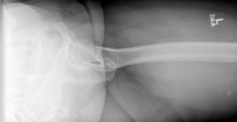 Illustration 5 for Periacetabular Osteotomy: End Hip Pain, Improve Flexion and Internal Motion