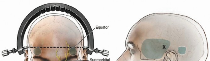 Master Techniques for Cervical Fracture Reduction: Type III & More