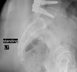 Illustration 5 for Adjacent Segment Degeneration: Your Next Spine Case Solved