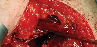 Illustration 70 for Unlock the Figure Posterior Approach to the Hip