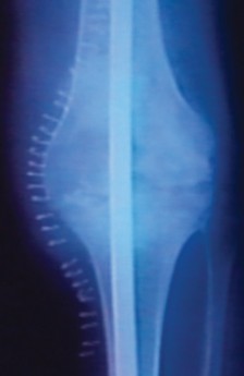 Illustration of arthrodesis with an intramedullary - Dr. Mohammed Hutaif