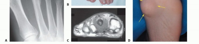 صورة طبية: أورام القدم: دليلك الشامل للعلاج، البتر، والاستئصال مع الأستاذ الدكتور محمد هطيف في صنعاء