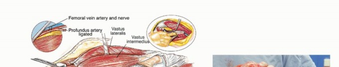 Illustration 25 for Beyond Amputation: Total Femur Resection with Endoprosthetics