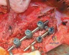 هل يختفي الألم تمامًا بعد جراحة استبدال المفصل؟ دليل شامل للمرضى