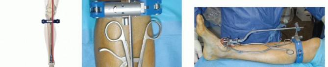 Illustration 12 for HINTEGRA Total Ankle: Unlocking Natural Ankle Movement