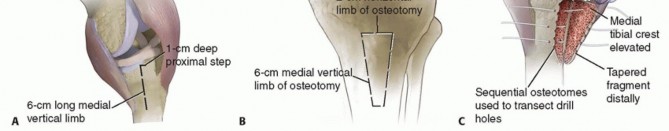 Illustration 10 for Tibial Tubercle Osteotomy: The Key to Extensile Exposure in Revision TKA