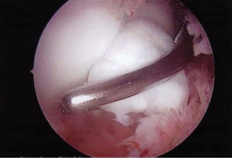 Illustration 96 for Right Shoulder Pain? Avoid This Common X-ray Mistake.