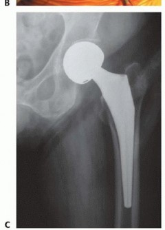 صورة طبية: نصف مفصل الورك: دليلك الشامل لدواعي الاستخدام والأنواع في صنعاء