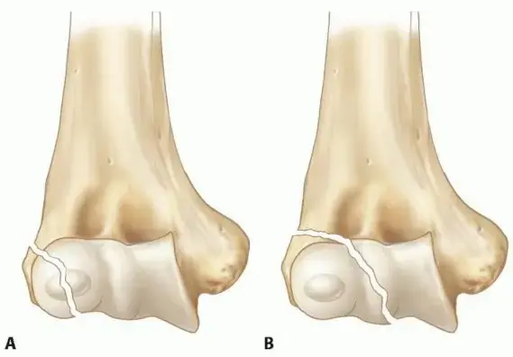 كسور الكوع عند الأطفال: دليل شامل لكسور اللقمة الوحشية وعلاجها المتقدم مع الدكتور محمد هطيف