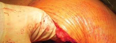 صورة طبية: تقنية الجذع القصير لاستبدال مفصل الورك الكلي: نهج الأستاذ الدكتور محمد هطيف لتدخل جراحي أقل ونتائج أفضل