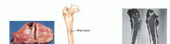 صورة توضيحية لـ أورام العظام والأنسجة الرخوة: دليلك الشامل للفهم والعلاج مع الأستاذ الدكتور محمد هطيف
