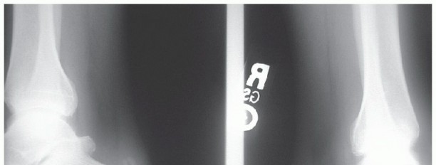 Achilles Tendinosis Relief: Flexor Hallucis Longus Tendon Augmentation