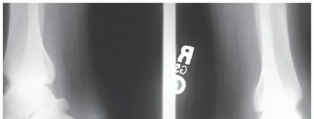 التهاب وتر أخيل الإدخالي: دليلك الشامل للعلاج والتعافي في اليمن والخليج مع البروفيسور محمد هطيف