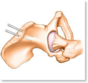Key Approaches for External Fixation: Humerus, Radius, Ulna, Wrist