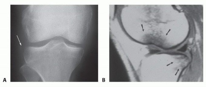 Illustration of patellar tendon graft - Dr. Mohammed Hutaif