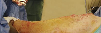 Illustration 60 for Unlock the Figure Posterior Approach to the Hip